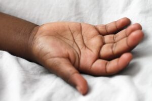 脂漏性皮膚炎が原因の薄毛、20代で悩むあなたに知ってほしい対策は？